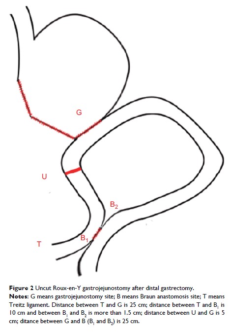 Figure 2 Uncut Roux-en-Y gastrojejunostomy after distal gastrectomy.