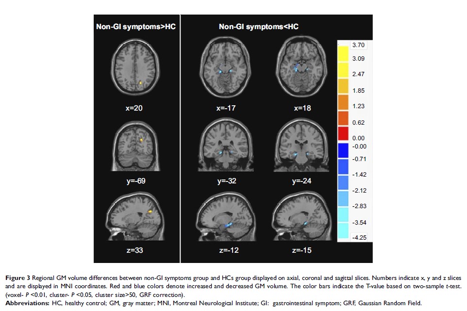 Figure 3 Regional GM volume differences between non-GI symptoms group and...