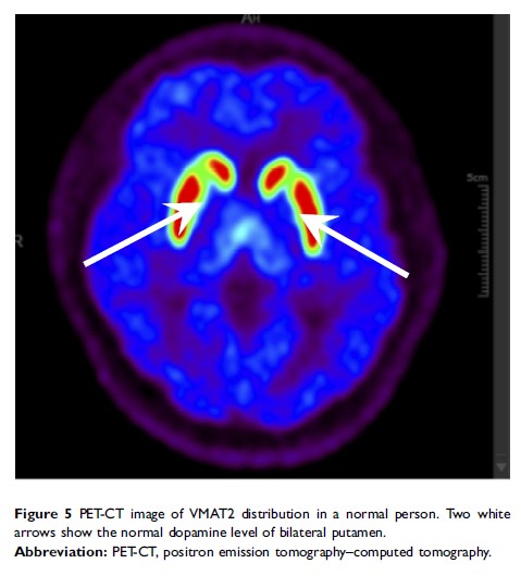 Figure 5 PET-CT image of VMAT2 distribution in a normal person...