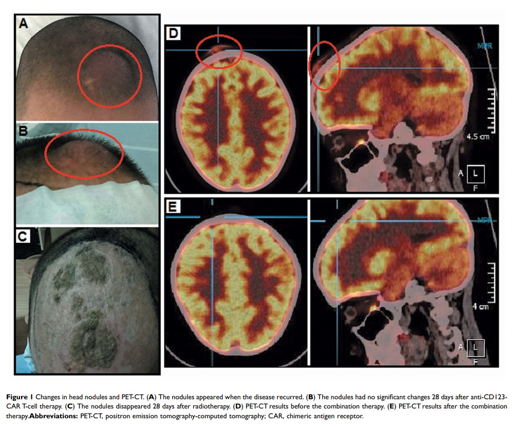 Figure 1 Changes in head nodules and PET-CT...