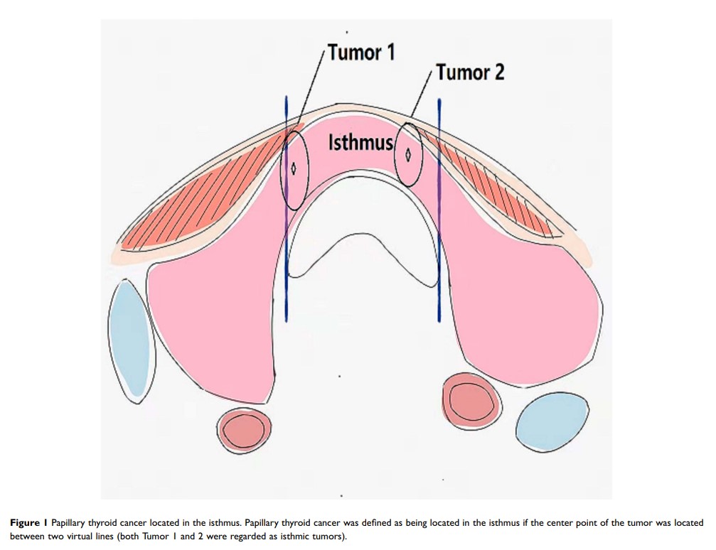 Figure 1 Papillary thyroid cancer located in the isthmus...