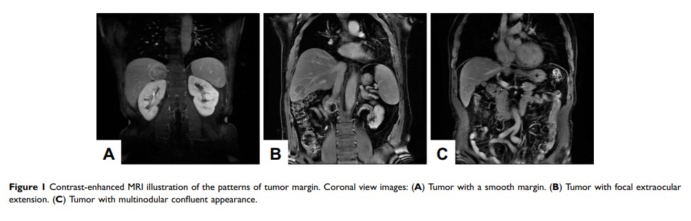 Figure 1 Contrast-enhanced MRI illustration of the patterns of tumor margin...
