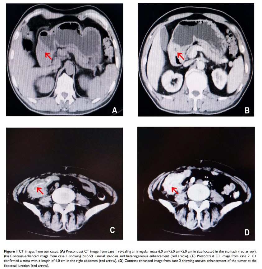 Figure 1 CT images from our cases...