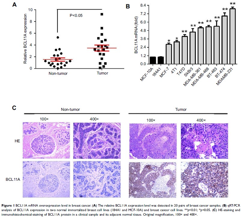 Figure 1 BCL11A mRNA overexpression level in breast cancer. (A) The relative BCL11A expression level was...