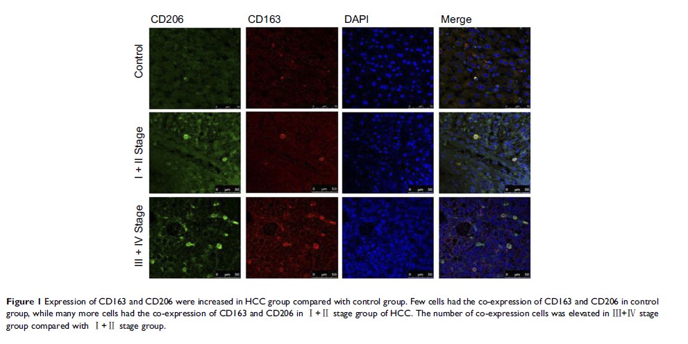 Figure 1 Expression of CD163 and CD206 were increased in HCC group compared with...