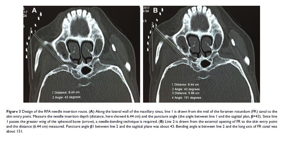 Figure 3 Design of the RFA needle insertion route...