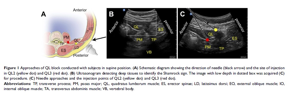 Figure 1 Approaches of QL block conducted with subjects in supine position...