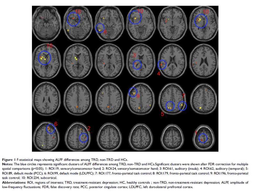 Figure 1 F-statistical maps showing ALFF differences among TRD, non-TRD and HCs.