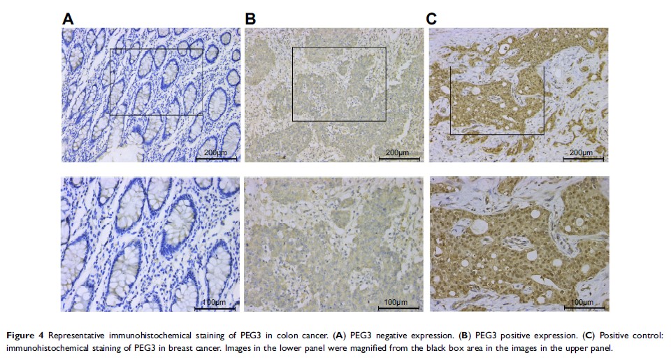 Figure 4 Representative immunohistochemical staining of PEG3 in colon cancer...