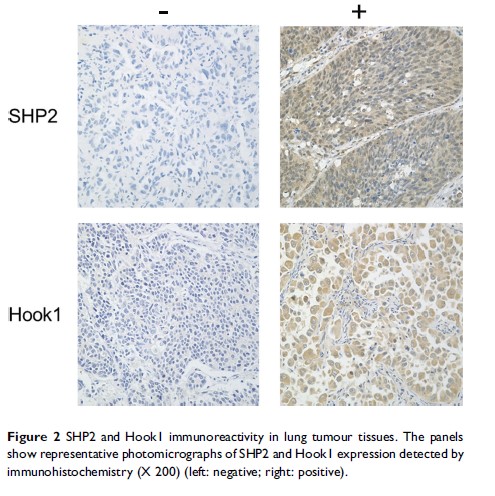 Figure 2 SHP2 and Hook1 immunoreactivity in lung tumour tissues...