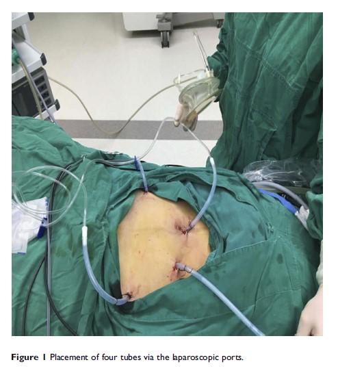 Figure 1 Placement of four tubes via the laparoscopic ports.