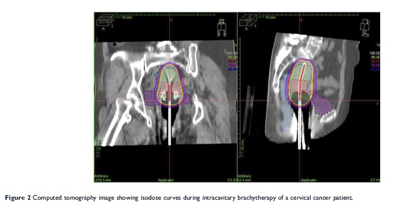 Figure 2 Computed tomography image showing isodose curves during...