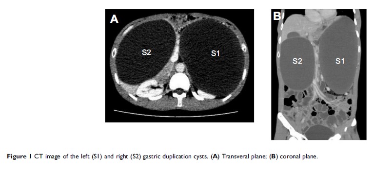 Figure 1 CT image of the left (S1) and right (S2) gastric duplication cysts...