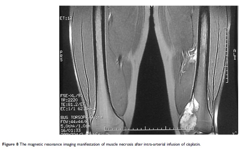 Figure 8 The magnetic resonance imaging manifestation of...