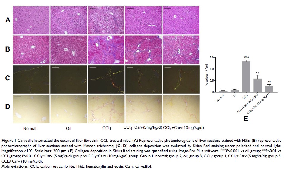 Figure 1 Carvedilol attenuated the extent of liver fibrosis in...