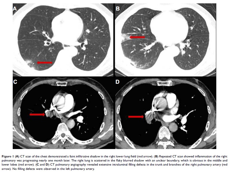 Figure 1 (A) CT scan of the chest demonstrated a faint infiltrative shadow in...