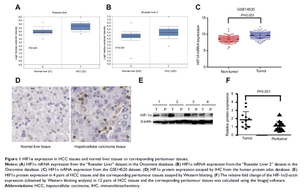 Figure 1 HIF1α expression in HCC tissues and...