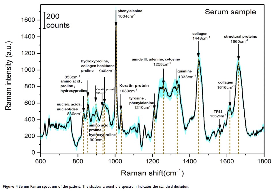 Figure 4 Serum Raman spectrum of the patient...