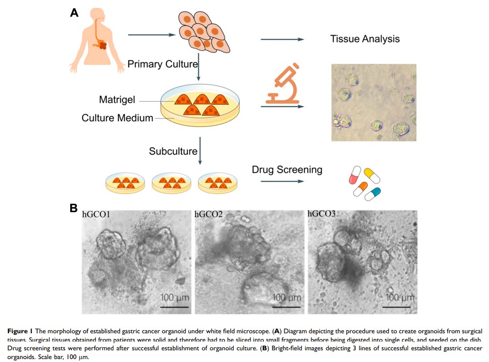 Figure 1 The morphology of established gastric cancer organoid under white field microscope...